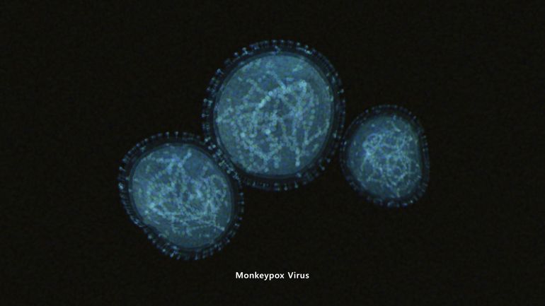 220 cas confirmés de variole du singe dans 19 pays hors Afrique